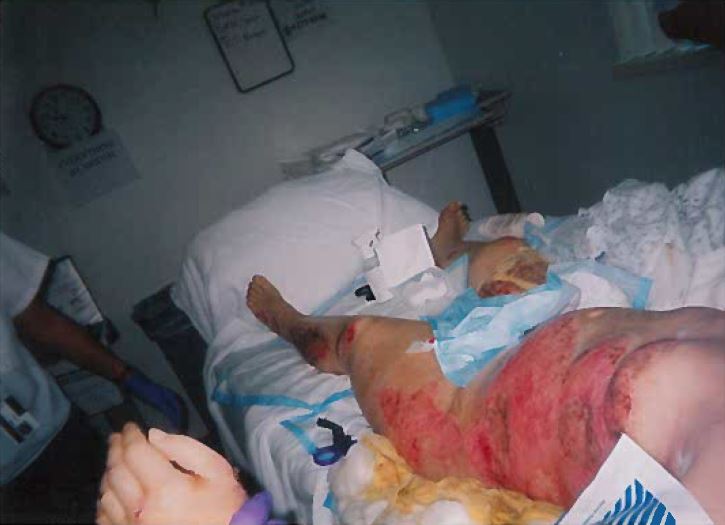 Rash and associated injuries from the crash