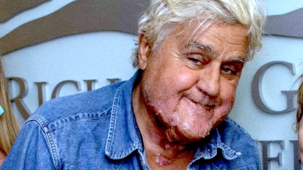 Jay Leno showing off the recovering burns received from his steam car. Media sourced from Entertainment Tonight.