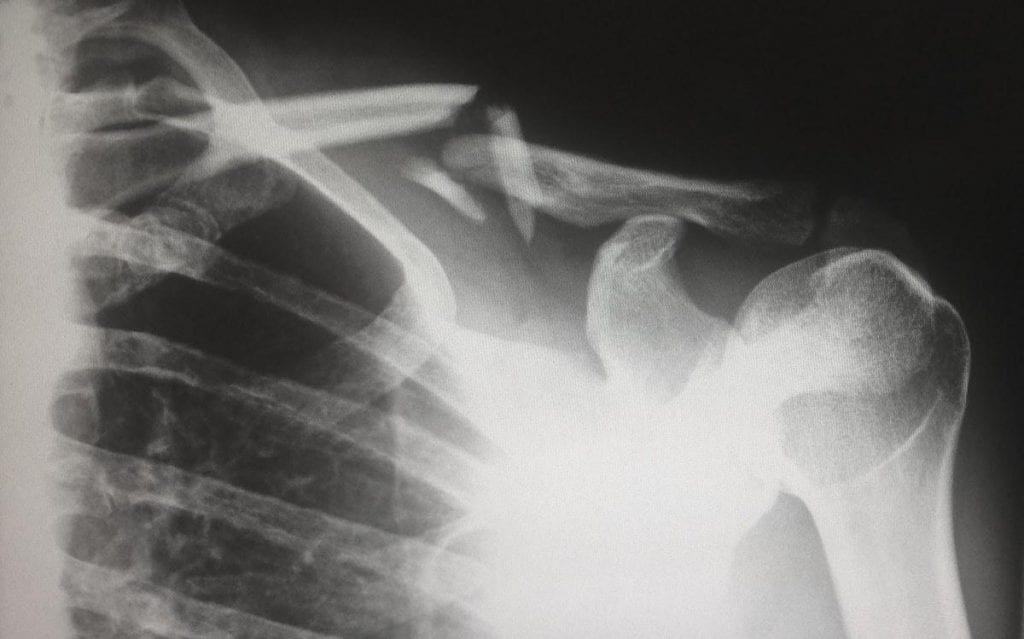 motorcycle injury xray